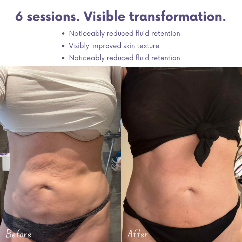 SculptLift Pro™ — Cellulite Vacuum Massager