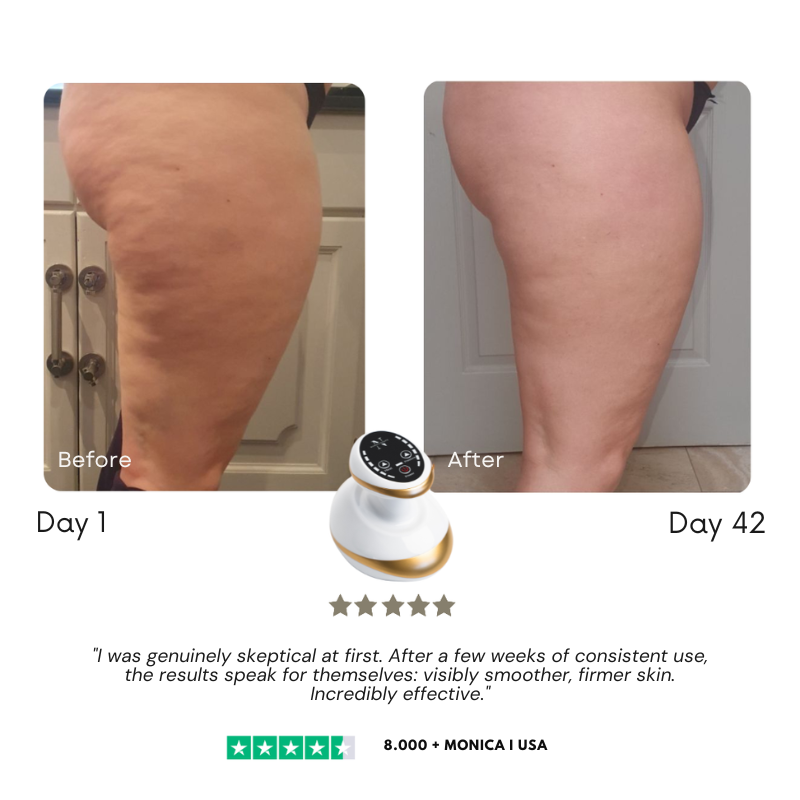 SculptLift Pro™ — Cellulite Vacuum Massager