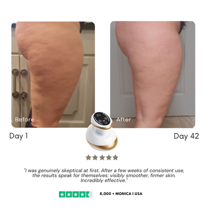 SculptLift Pro™ — Cellulite Vacuum Massager