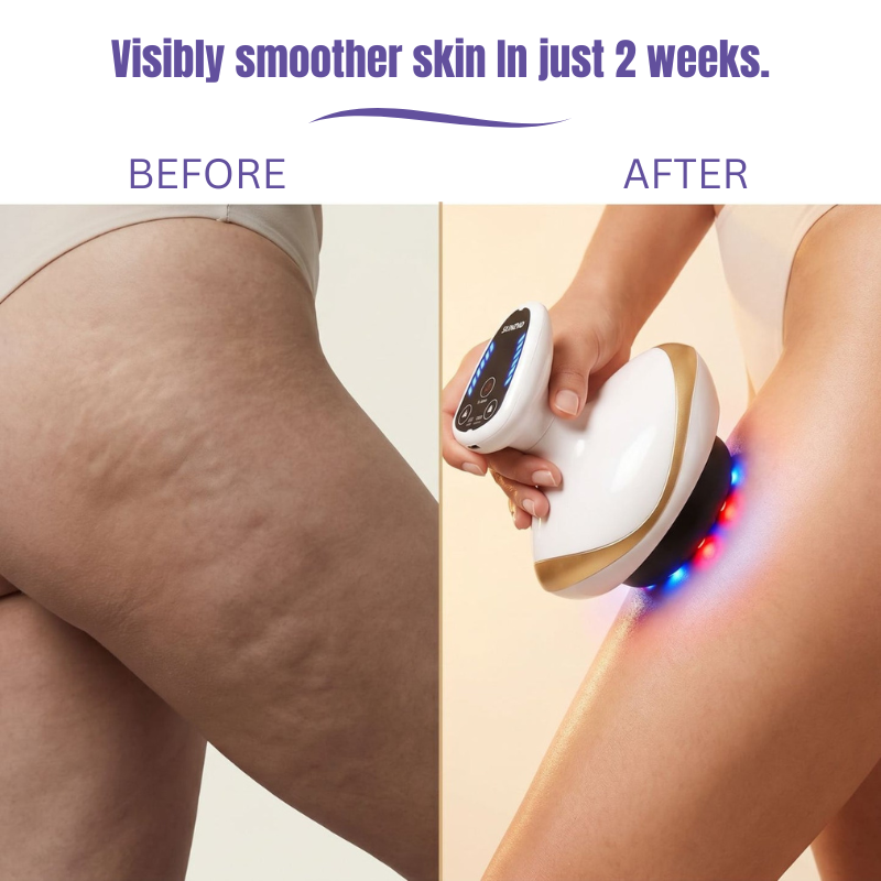 SculptLift Pro™ — Cellulite Vacuum Massager